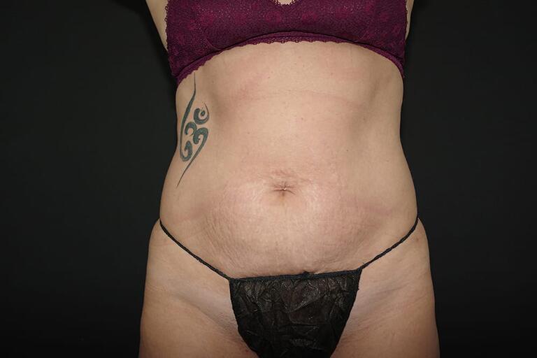 Smartlipo Before & After Image