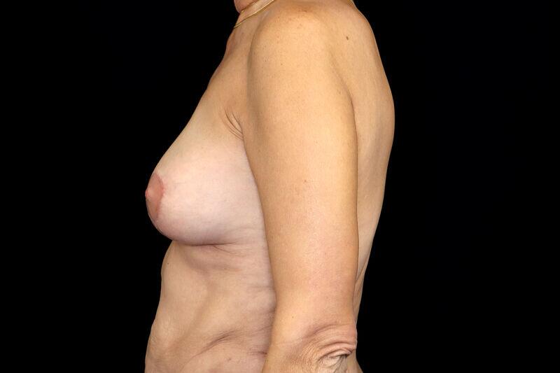 Breast Fat Transfer Before & After Image