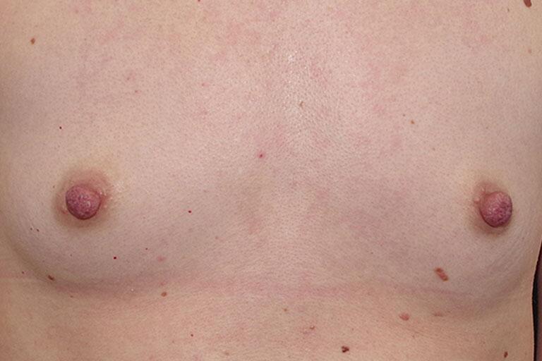 Nipple Reduction Before & After Image