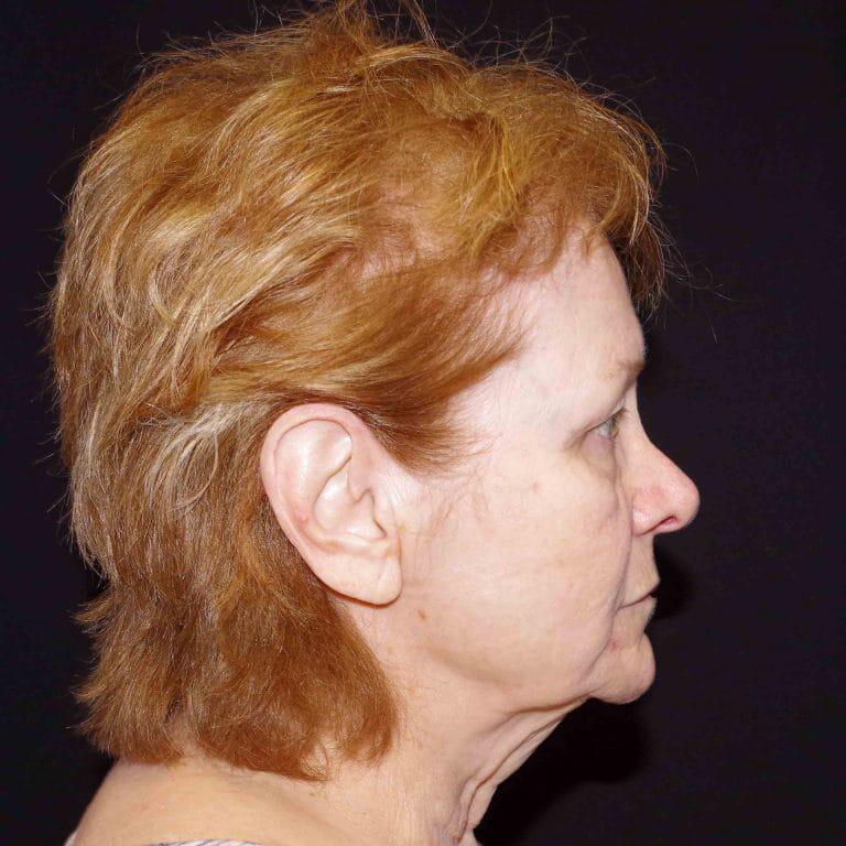 Mini Facelift Before & After Image