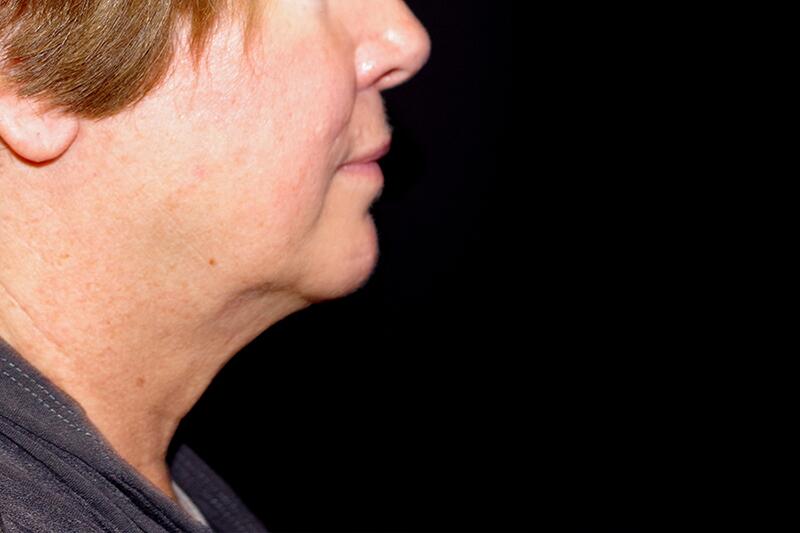 CoolSculpting CoolMini Before & After Image